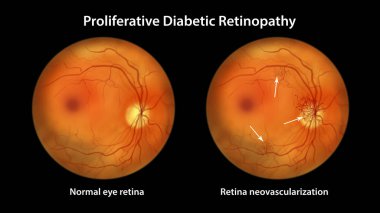 Proliferatif diyabetik retinopati, optik disk ve diğer sitelerde yeni damarların oluşumunu gösteren illüstrasyon. Göz retinasının diyabetteki Fundoskopik muayenesi