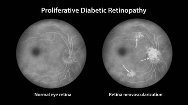 Üretken diyabetik retinopati, optik diskte ve diğer sitelerde neovaskülarizasyonu gösteren illüstrasyon. Göz retinasının diyabet, mellitus ve florasan anjiyografisinde Fundoskopik incelemesi