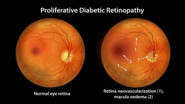 Üretken diyabetik retinopati, diskte ve diğer sitelerde neovascularizasyon ve macula ödemi gösteren illüstrasyon. Göz retinasının diyabetteki Fundoskopik muayenesi
