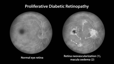Üretken diyabetik retinopati, diskte ve diğer sitelerde neovascularizasyon ve macula ödemi gösteren illüstrasyon. Göz retinası diyabetik mellitus, florasan anjiyografi.