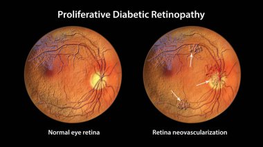 Proliferatif diyabetik retinopati, optik disk ve diğer sitelerde yeni damarların oluşumunu (yeni damarların oluşumunu) gösteren üç boyutlu illüstrasyon. Göz retinasının şeker hastalığında muayenesi