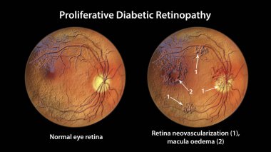 Üretken diyabetik retinopati, diskte ve diğer sitelerde neovascularizasyon gösteren üç boyutlu illüstrasyon ve macula ödemi. Göz retinasının diyabetteki Fundoskopik muayenesi