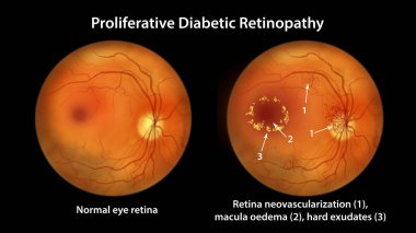 Proliferative diabetic retinopathy, illustration showing neovascularization in the disk and other sites, macula edema and hard exudates. Fundoscopic examination of the eye retina in diabetes mellitus clipart