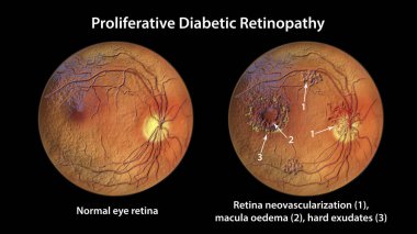 Üretken diyabetik retinopati, üç boyutlu illüstrasyon diskte ve diğer sitelerde neovaskülarizasyon, macula ödemi ve sert çıkıntılar gösteriyor. Göz retinasının diyabetteki Fundoskopik muayenesi