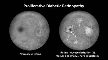 Üreme diyabetik retinopati, illüstrasyon diskte ve diğer sitelerde neovaskülarizasyon, sistoid macula ödemi ve sert çıkıntılar gösteriyor. Göz retinası diyabetik mellitus, florasan anjiyografi.