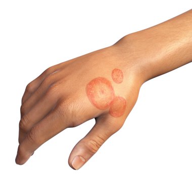 Fungal infection on a man's hand. Tinea manuum, 3D illustration