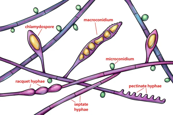 Mikroszkopikus Gombák Szerkezete Microsporum Audouinii Illusztráció Antrophil Dermatophyte Gomba Elsősorban — Stock Fotó