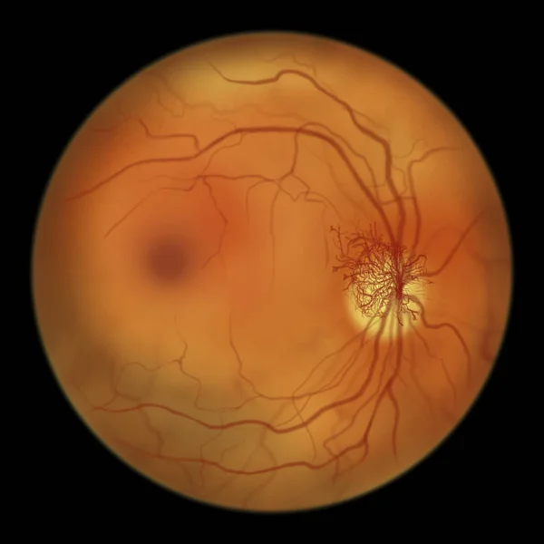Non Proliferative Diabetic Retinopathy Illustration Showing Venous