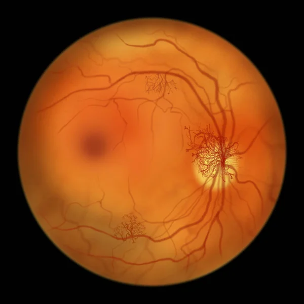 Proliferative Diabetic Retinopathy Illustration Showing Neovascularization Formation New Vessels Optic — Fotografia de Stock