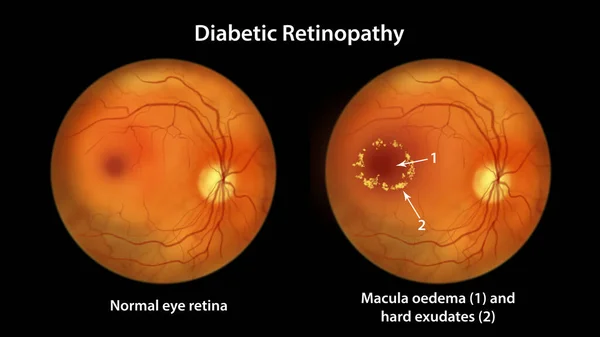 Retinopatia Cukrzycowa Ilustracja Ukazująca Obrzęk Plamki Żółtej Twarde Wysięki Nieprawidłowe — Zdjęcie stockowe