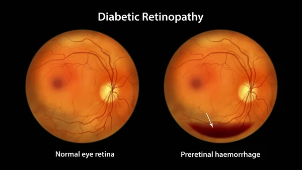 Retinopatia Cukrzycowa Ilustracja Pokazuje Krwotok Przedporodowy Jako Poziom Poziomy Krwi — Zdjęcie stockowe