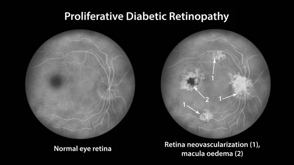 Proliferative Diabetic Retinopathy Illustration Showing Neovascularization Disk Other Sites Macula — Foto de Stock