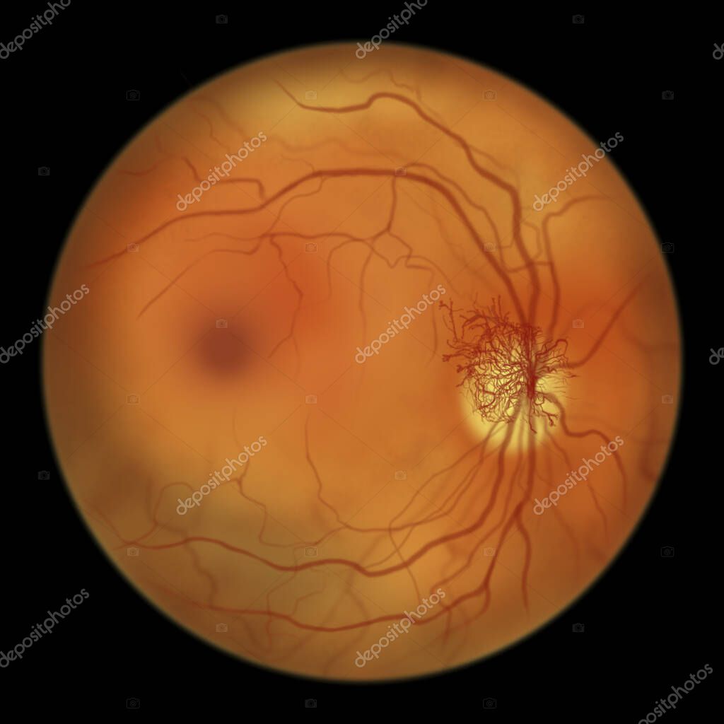 Proliferative diabetic retinopathy, illustration showing