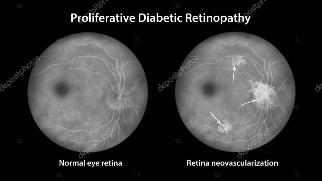 Proliferative diabetic retinopathy, illustration showing