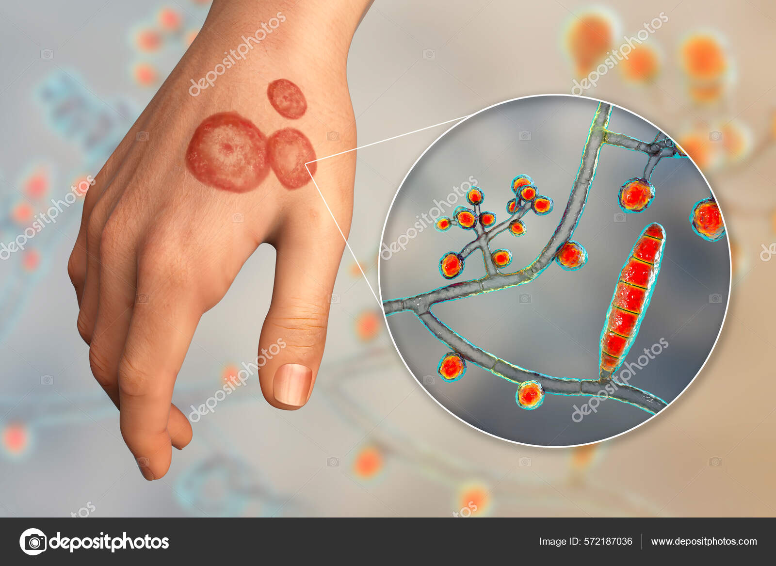 Fungal Infection Human Hand Ringworm Tinea Manuum Close View Dermatophyte Stock Photo by