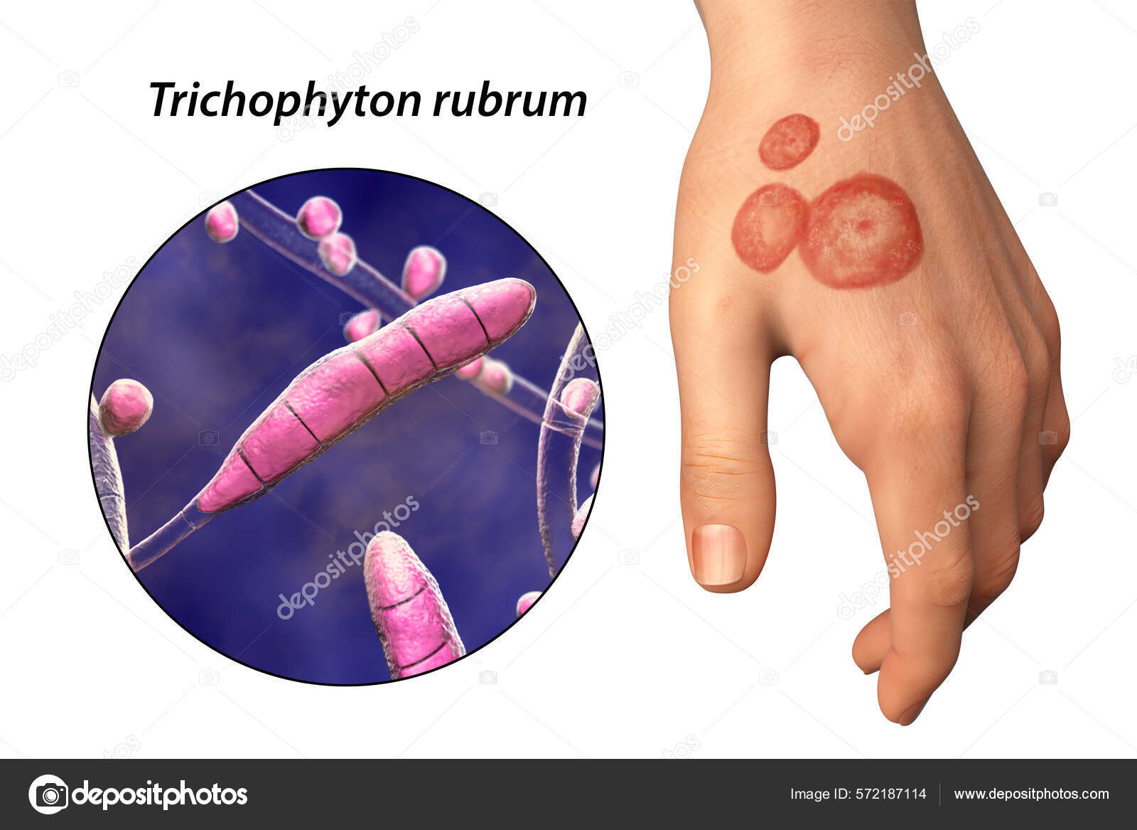 Fungal Infection Man's Hand Tinea Manuum Close View Dermatophyte Fungi —  Fotografias de Stock © katerynakon #572187114