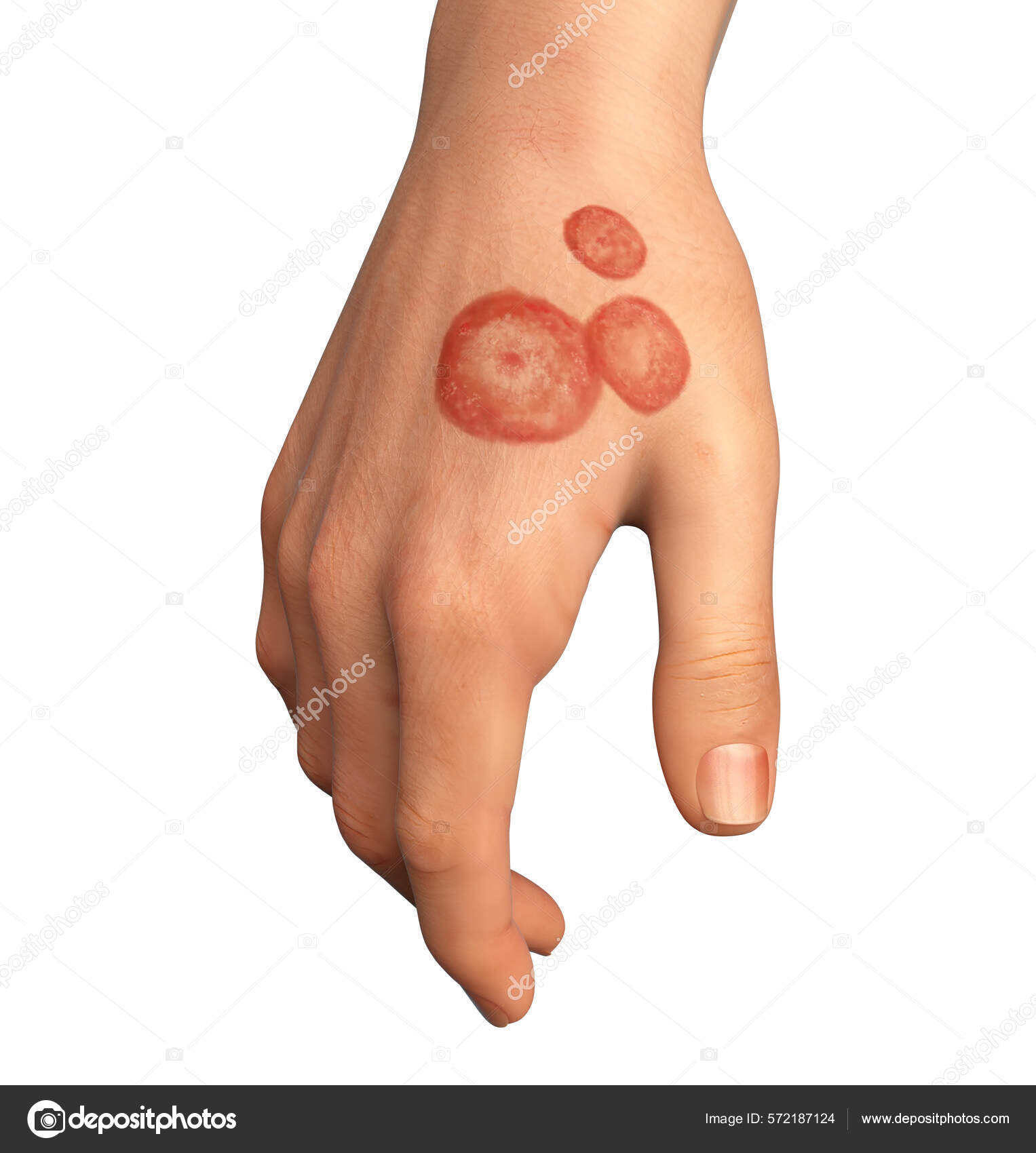 Fungal Infection Man's Hand Tinea Manuum Illustration Stock Photo