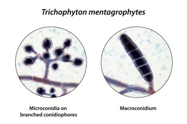 Mantar Trichophyton mentagrophytes, 3 boyutlu illüstrasyon dallanmış konidiyoforları gösteriyor küresel mikrokonidia, makrokonidium, sept ve spiral hyphae taşıyor. Mantar, saç ve tırnak enfeksiyonlarına neden olur.