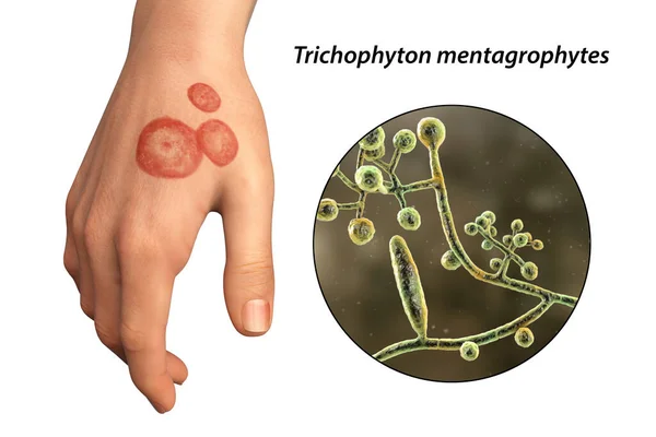 Fungal infection on a human hand. Ringworm, tinea manuum and close-up view of dermatophyte fungi Trichophyton mentagrophytes, 3D illustration