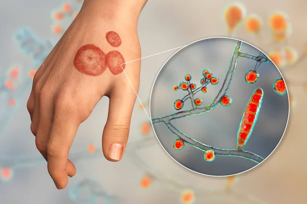 Infección Fúngica Una Mano Humana Ringworm Tinea Manuum Close View — Foto de Stock