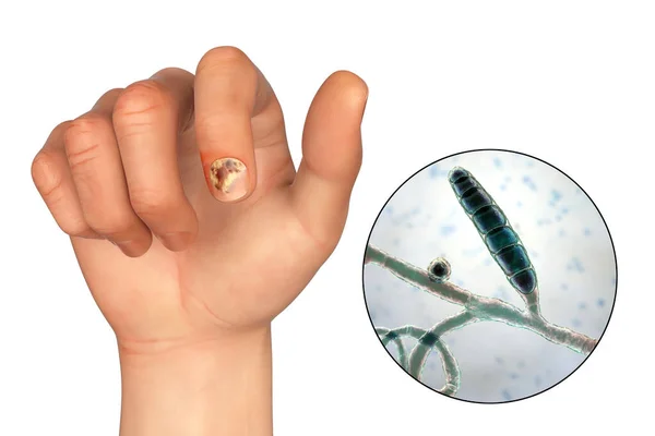 爪の感染症の原因物質の1つであるトリコピトン メンタルアグロフィテス真菌のオンコシスとクローズアップビューを持つヒトの手 3Dイラスト — ストック写真