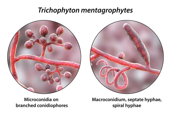 Fungos Trichophyton Mentagrophytes Ilustração Mostrando Conidióforos Ramificados Com Microconídios Esféricos — Fotografia de Stock