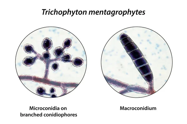 Fungi Trichophyton Mentagrophytes 3Dイラストは 球状微生物叢 マクロコンジウム 分離およびスパイラルハイフーを有する分岐コンジオフォアを示しています 原因リングワーム 髪や爪の感染症 — ストック写真