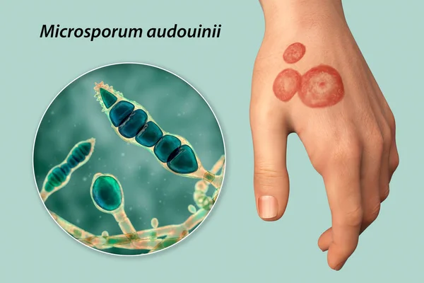 Fungal Infection Human Hand Tinea Manuum Close View Dermatophyte Fungi — Stock Photo, Image