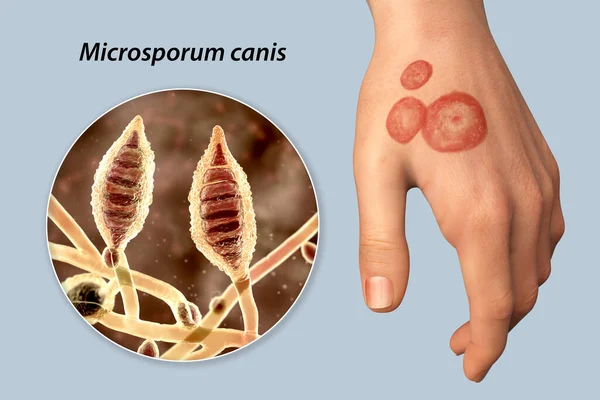 Fungal infection on a human hand. Tinea manuum and close-up view of dermatophyte fungi Microsporum canis, 3D illustration