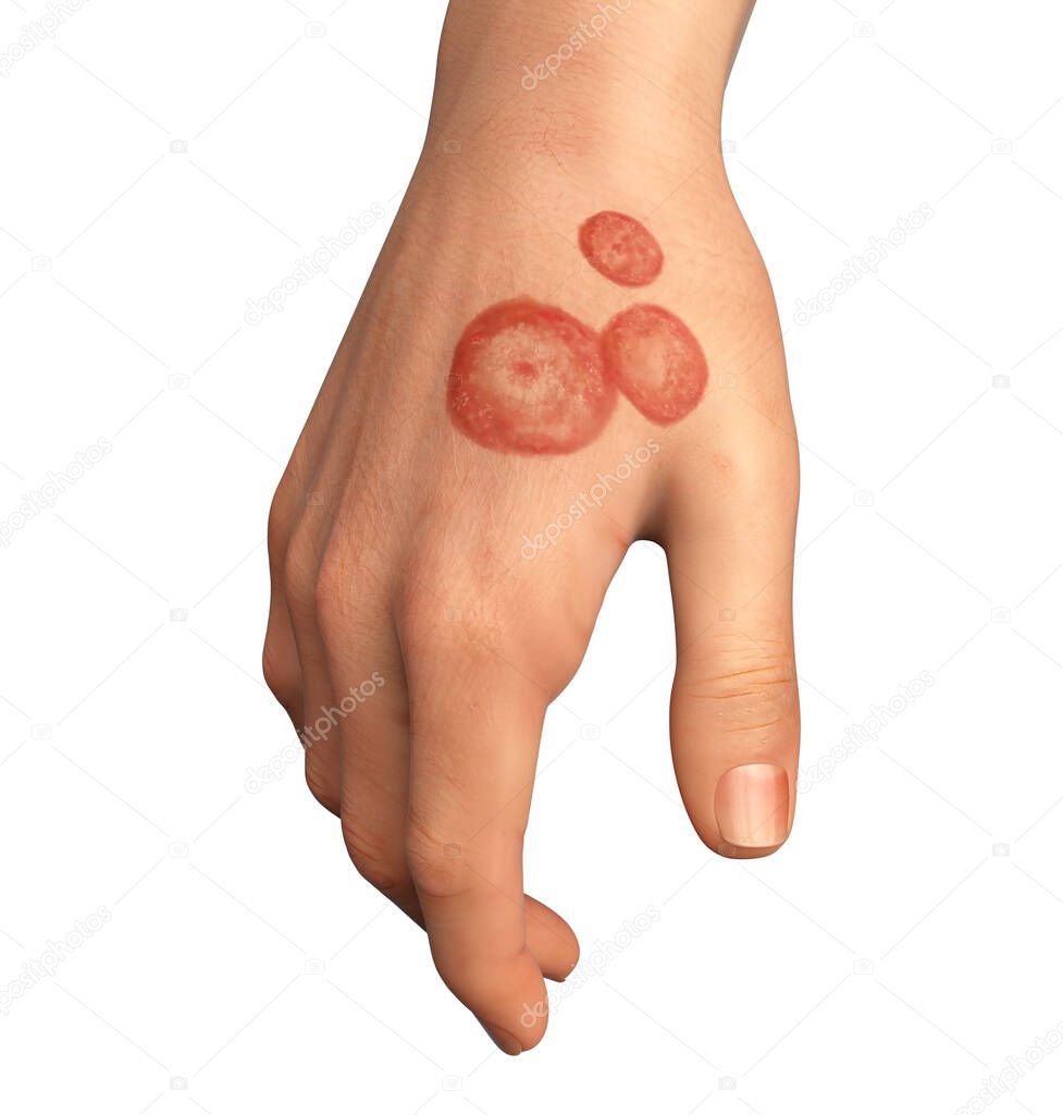Fungal infection on a man's hand. Tinea manuum, 3D illustration