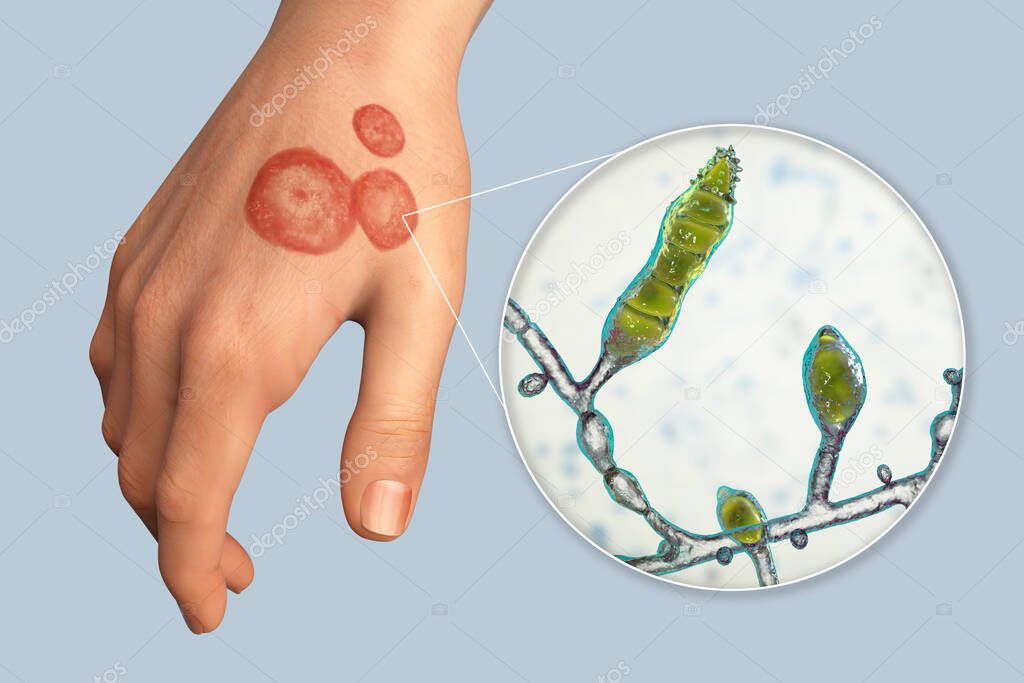 Fungal infection on a human hand. Tinea manuum and close-up view of dermatophyte fungi Microsporum audouinii, 3D illustration