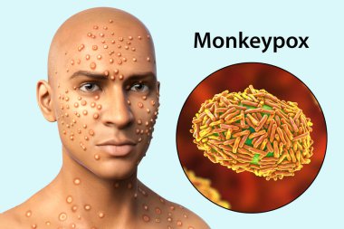 Maymun çiçeği hastası ve maymun çiçeği virüsünün yakın plan görüntüsü, 3 boyutlu illüstrasyon. Maymun Çiçeği, Poxviridae familyasından bir zoonotik virüstür.