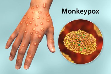 Maymun çiçeği enfeksiyonu olan bir hastanın eli, üç boyutlu illüstrasyon. Maymun Çiçeği, Poxviridae familyasından bir zoonotik virüstür.