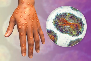 Hand of a patient with monkeypox infection, 3D illustration. Monkeypox is a zoonotic virus from Poxviridae family, causes monkeypox, a pox-like disease clipart