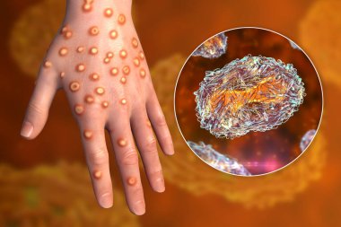 Hand of a patient with monkeypox infection, 3D illustration. Monkeypox is a zoonotic virus from Poxviridae family, causes monkeypox, a pox-like disease clipart