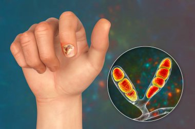 Human hand with onychomycosis and close-up view of Epidermophyton floccosum fungi, one of the causative agents of nail infections, 3D illustration clipart