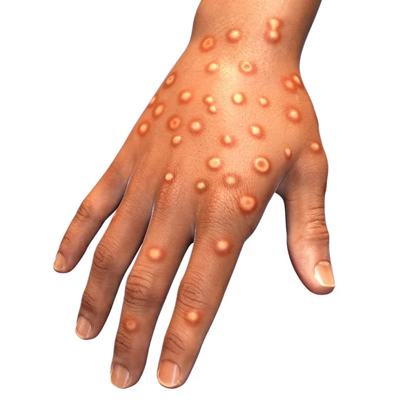 一个感染猴痘的病人的手 3D插图 猴痘是一种由Poxviridae家族产生的动物病毒 它引起猴痘 一种类似痘痘的疾病 — 图库照片