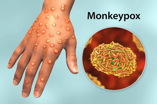 Χέρι Ασθενούς Λοίμωξη Από Ευλογιά Μαϊμούς Τρισδιάστατη Απεικόνιση Monkeypox Είναι — Φωτογραφία Αρχείου