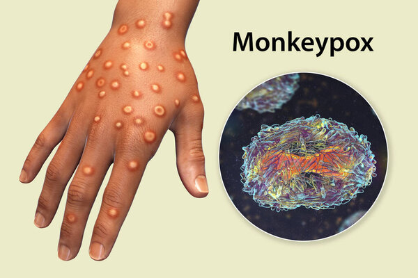 Hand of a patient with monkeypox infection, 3D illustration. Monkeypox is a zoonotic virus from Poxviridae family, causes monkeypox, a pox-like disease