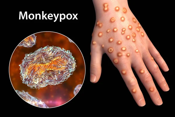 Maymun çiçeği enfeksiyonu olan bir hastanın eli, üç boyutlu illüstrasyon. Maymun Çiçeği, Poxviridae familyasından bir zoonotik virüstür.