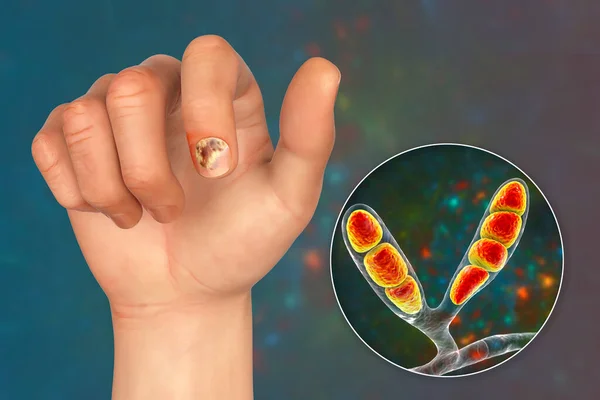 Mano Humana Con Onicomicosis Vista Cerca Los Hongos Epidermophyton Floccosum — Foto de Stock