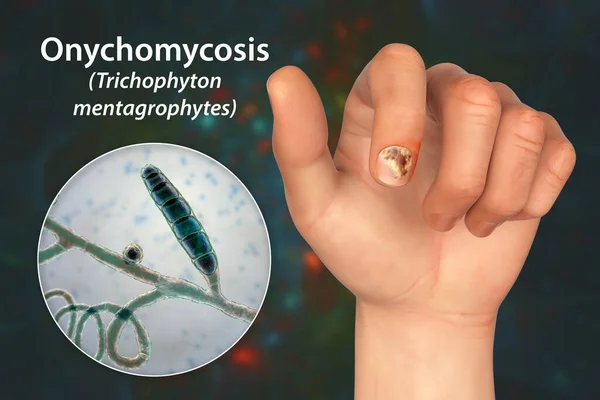 Mão Humana Com Onicomicose Visão Perto Dos Fungos Trichopyton Mentagrophytes — Fotografia de Stock