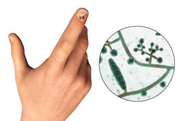人类手部感染了念珠菌病 并近距离观察了造成指甲感染的原因之一 三维图说明了这一点 — 图库照片