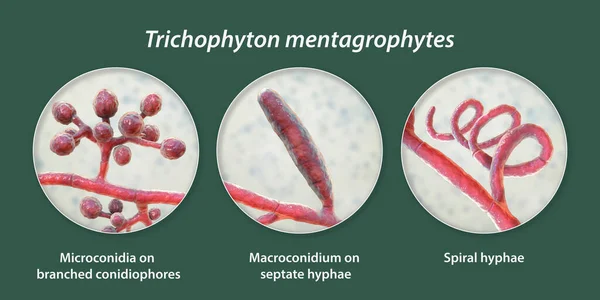 Gombák Trichophyton Mentagrophytes Illusztráció Mutatja Elágazó Conidiophores Viselő Gömb Alakú — Stock Fotó