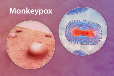 Maymun çiçeği enfeksiyonunda deri lezyonları ve maymun çiçeği virüsüne yakından bakma, üç boyutlu illüstrasyon. Poxviridae familyasından bir zoonotik virüs, çiçek benzeri bir hastalığa neden olur.