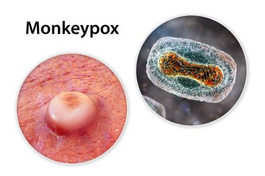 Maymun çiçeği enfeksiyonunda deri lezyonları ve maymun çiçeği virüsüne yakından bakma, üç boyutlu illüstrasyon. Poxviridae familyasından bir zoonotik virüs, çiçek benzeri bir hastalığa neden olur.