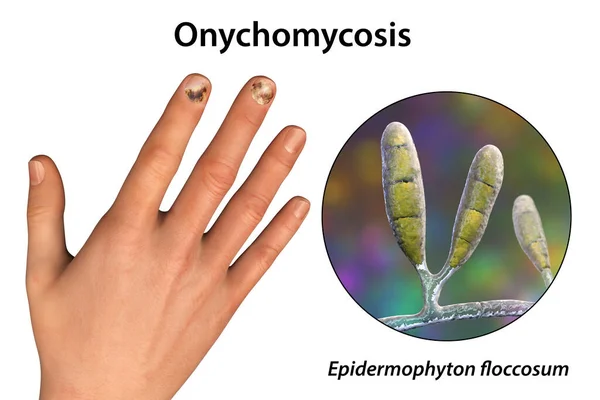爪の感染症の原因物質の一つであるエピデルモフィトンフロコサム真菌のヒト手とクローズアップビュー 3Dイラスト — ストック写真