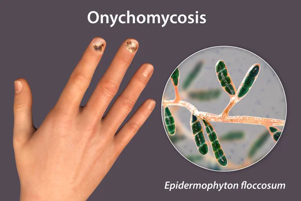 Mão Humana Com Onicomicose Visão Perto Dos Fungos Epidermophyton Floccosum — Fotografia de Stock