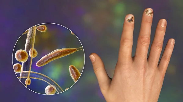 人的手与线虫病和特写镜头的Trichopyton Rubrum真菌 造成指甲感染的原因之一 3D说明 — 图库照片