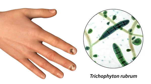 Human Hand Onychomycosis Close View Trichopyton Rubrum Fungi One Causative — Stock Photo, Image